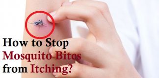 how to stop mosquito bites from itching