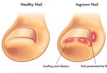 How to treat an ingrown toenail