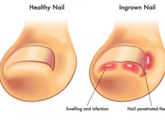 How to treat an ingrown toenail