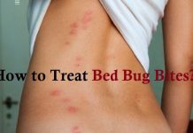 how to treat bed bug bites new