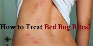 how to treat bed bug bites new