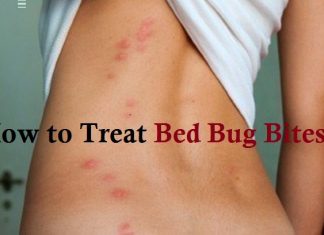 how to treat bed bug bites new