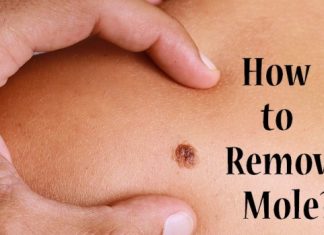 how to remove a mole