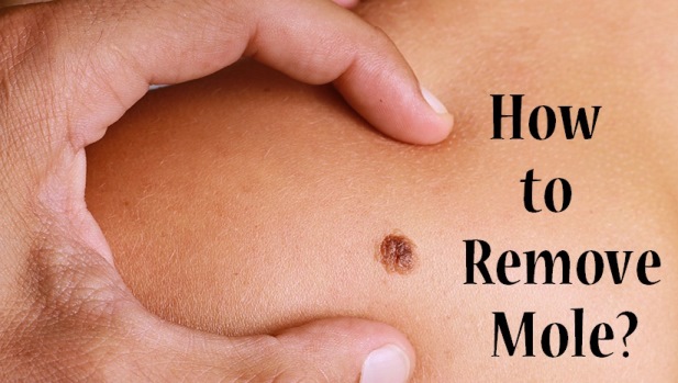 how to remove a mole