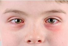 natural treatment for pink eye