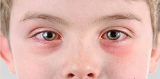 natural treatment for pink eye