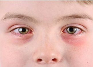 natural treatment for pink eye