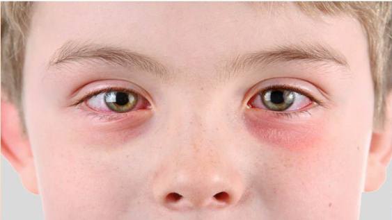 natural treatment for pink eye