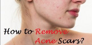 how to remove acne scars