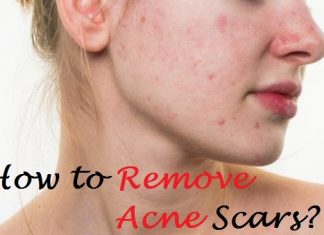 how to remove acne scars