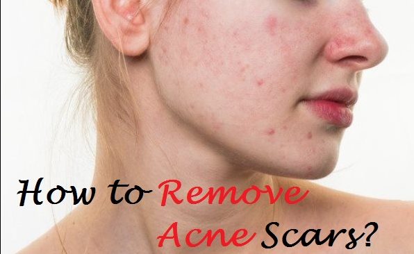 how to remove acne scars