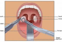 how to prevent tonsil stones