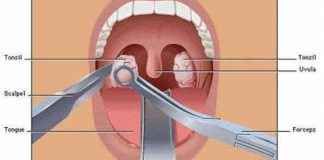 how to prevent tonsil stones