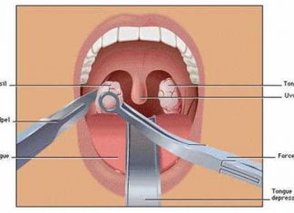 how to prevent tonsil stones