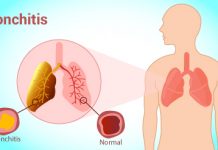 home remedies for bronchitis