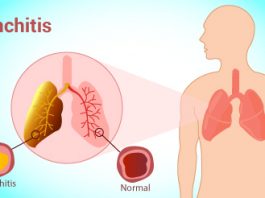 home remedies for bronchitis