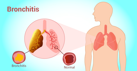 home remedies for bronchitis